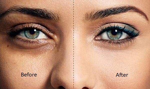 Image result for dark circles under eyes